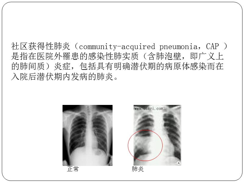 【肺炎PPT】社区获得性肺炎的诊断与治疗_第2页