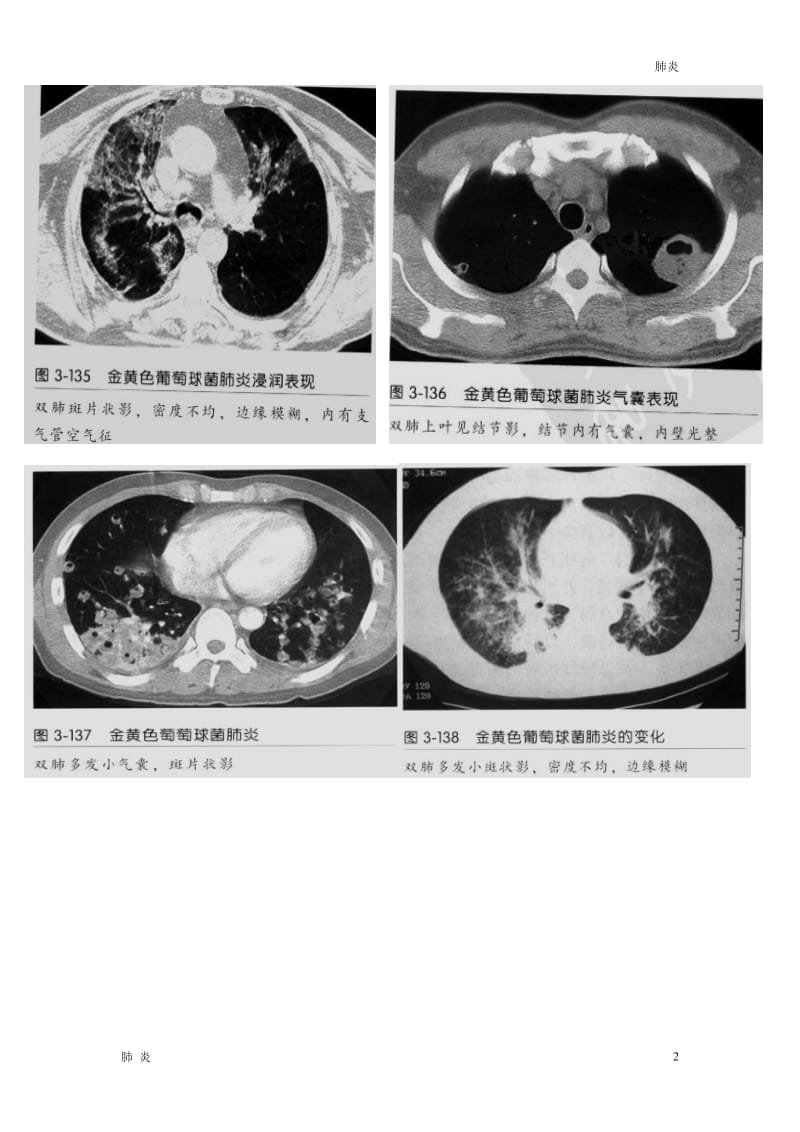 肺炎资料：金黄色葡萄球菌肺炎CT征象_第2页