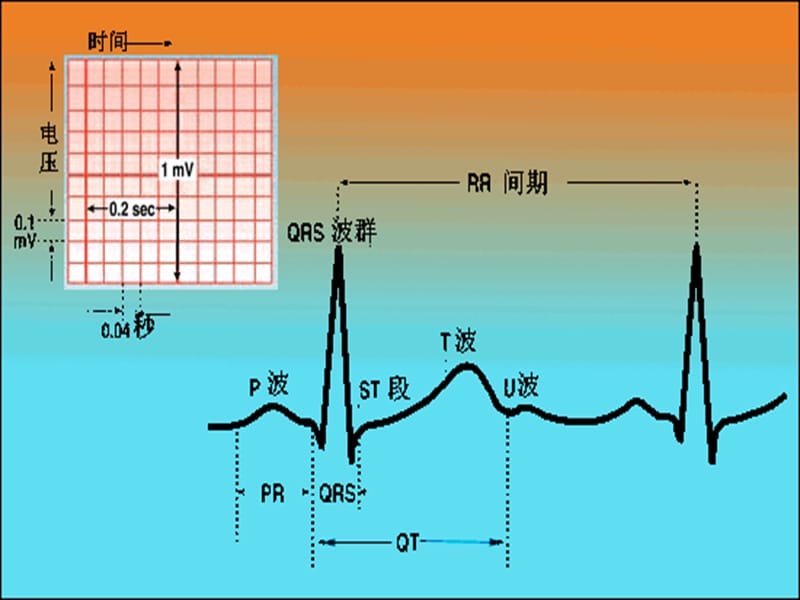 正常心电图及常见异常心电图的识别及处理_第3页