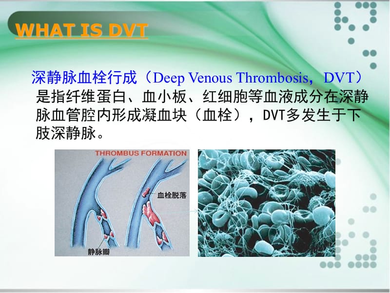 深静脉血栓形成诊治.ppt_第2页