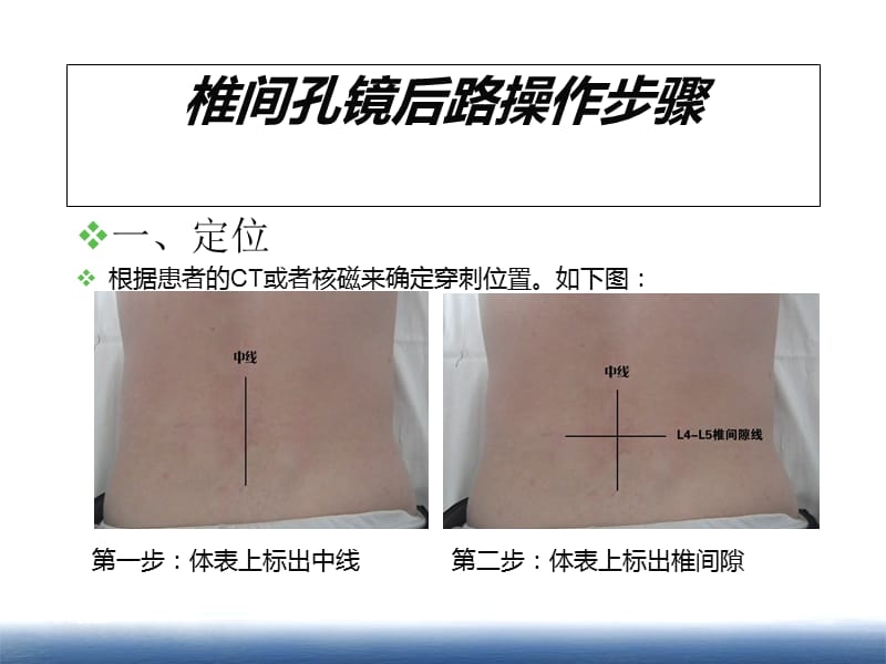 腰椎间盘突出症椎间孔镜后路操作步骤.ppt_第1页