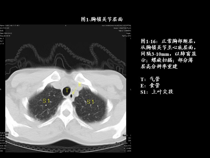最全胸部CT肺段划分.ppt_第1页