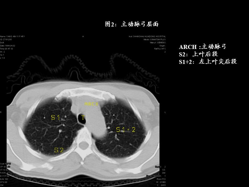 最全胸部CT肺段划分.ppt_第2页