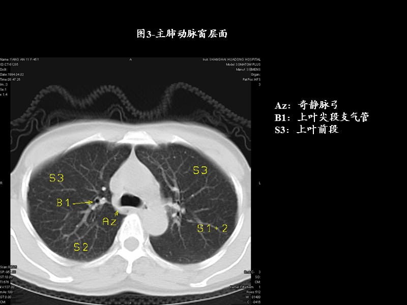 最全胸部CT肺段划分.ppt_第3页