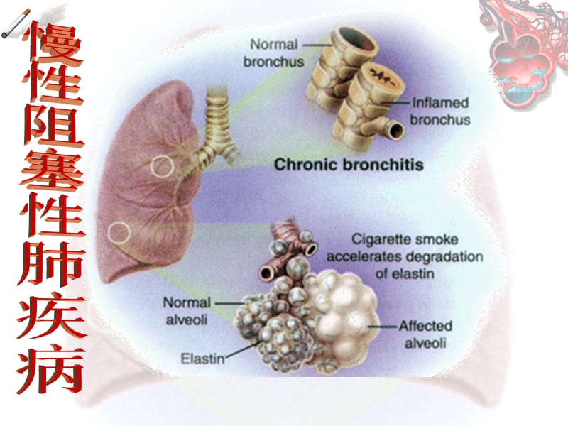 COPD慢性阻塞性肺疾病.ppt_第1页