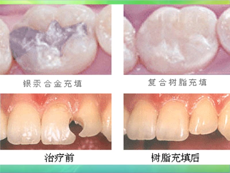 《牙科树脂充填》PPT课件.ppt_第1页