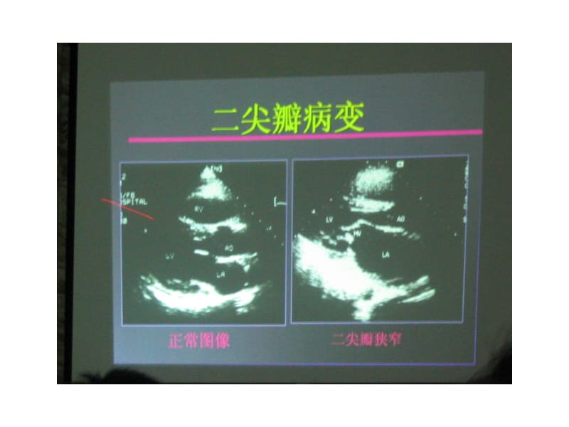 超声心动图在风心病中应用讲稿(上).ppt_第3页