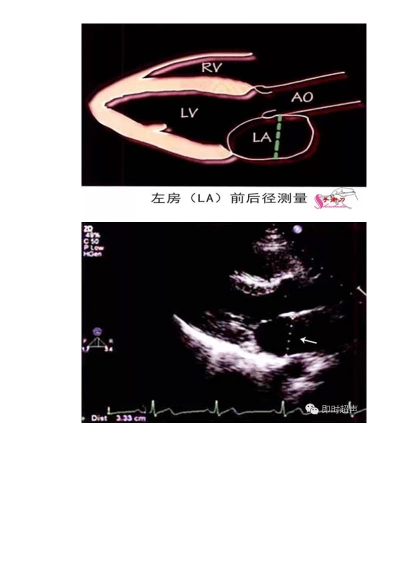 超声心动图测量技巧及图解.doc_第3页