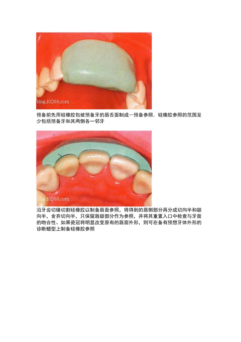 全瓷牙备牙方法图例.doc_第2页