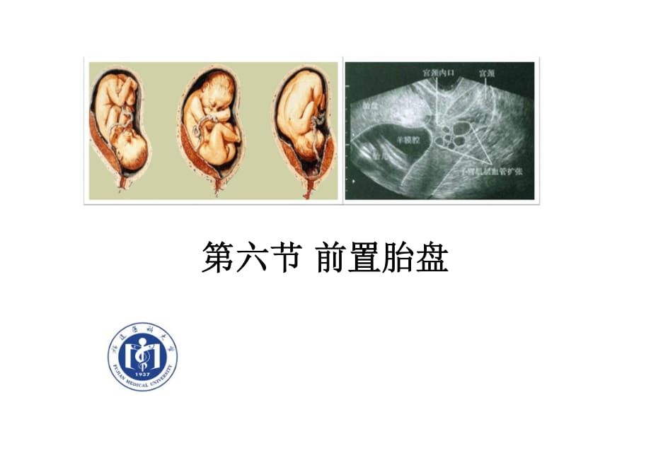 高級(jí)助產(chǎn)學(xué)第9章妊娠并發(fā)癥——前置胎盤(pán)、胎盤(pán)早剝.pdf_第1頁(yè)