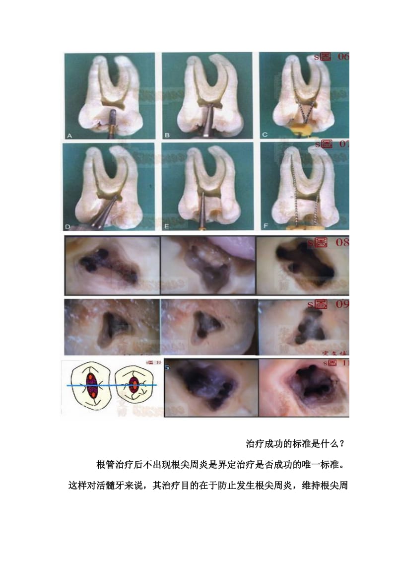 【口腔医学总结】脱下MB2的隐形衣（图片）_第3页