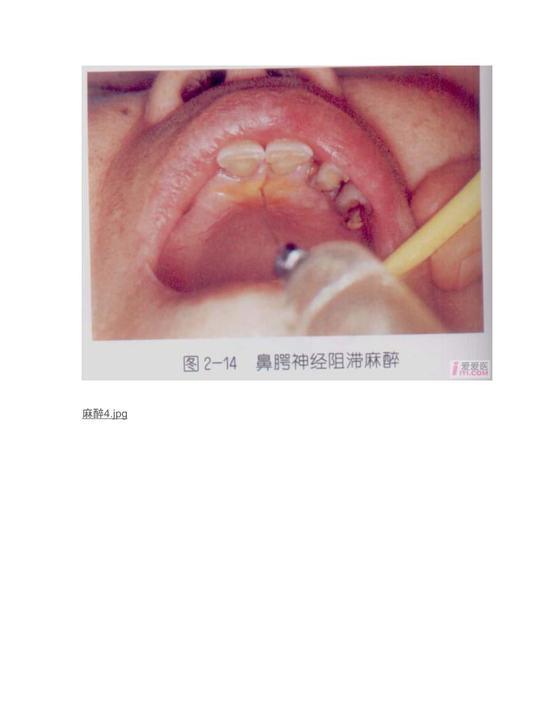 【口腔医学总结】口腔麻醉图片_第3页