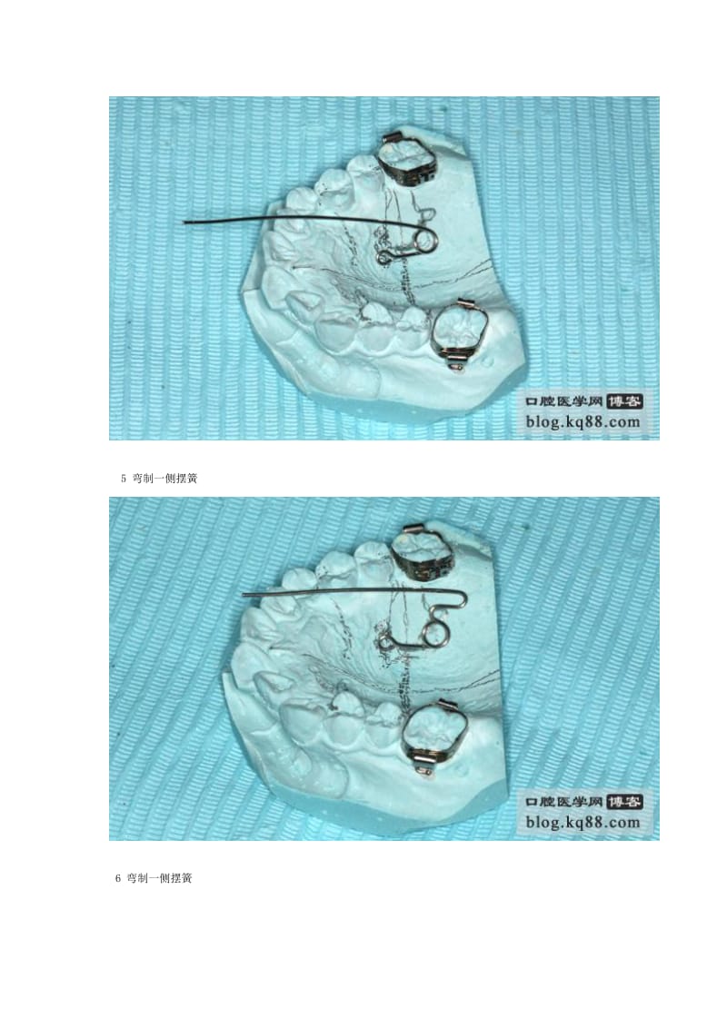 【口腔医学总结】跟我认识钟摆式矫治器-山东周医生_第3页