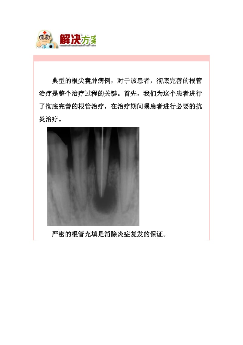 【口腔医学总结】根尖周囊肿的治疗_第2页