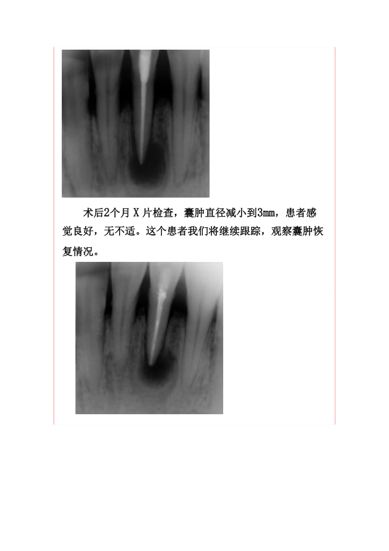 【口腔医学总结】根尖周囊肿的治疗_第3页