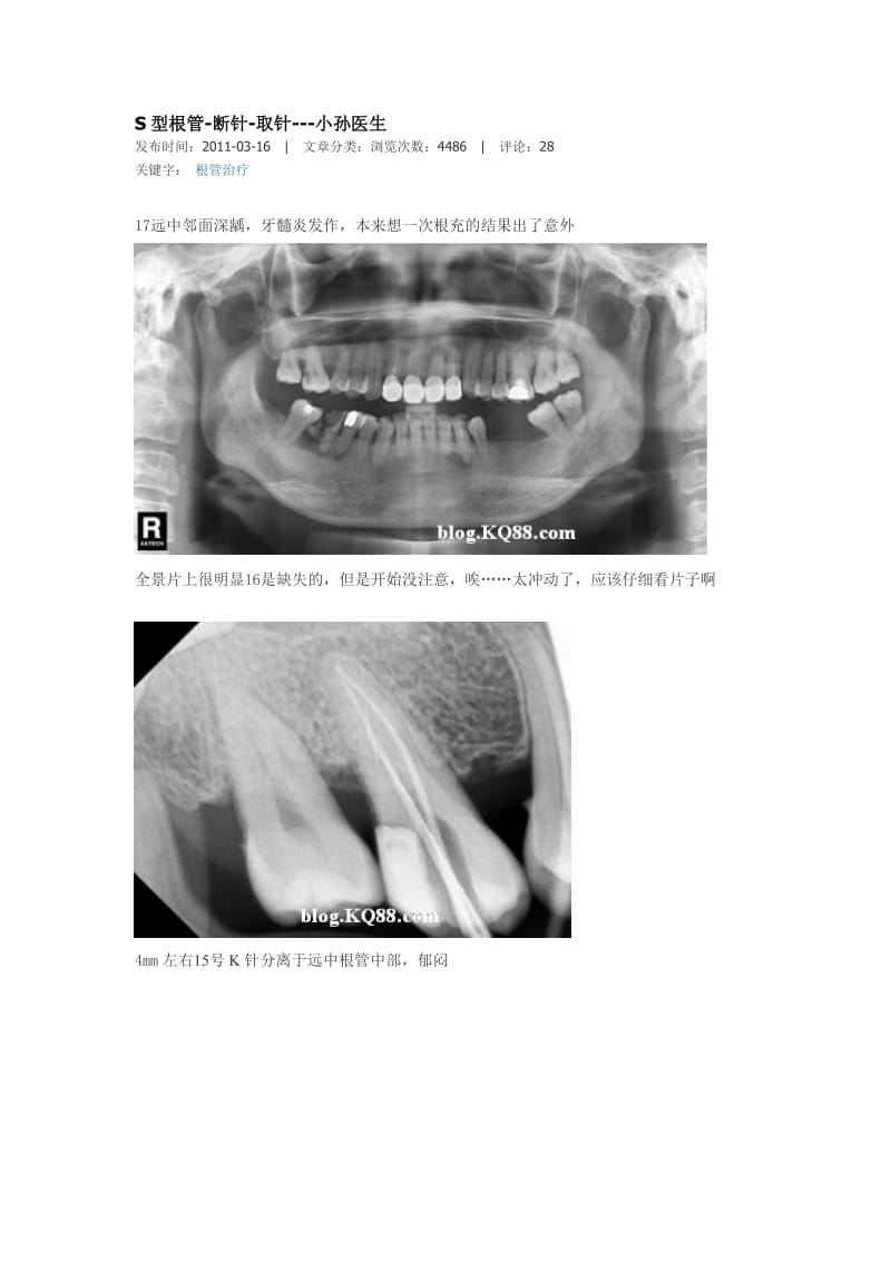 【口腔医学总结】S型根管-断针-取针---小孙医生_第1页