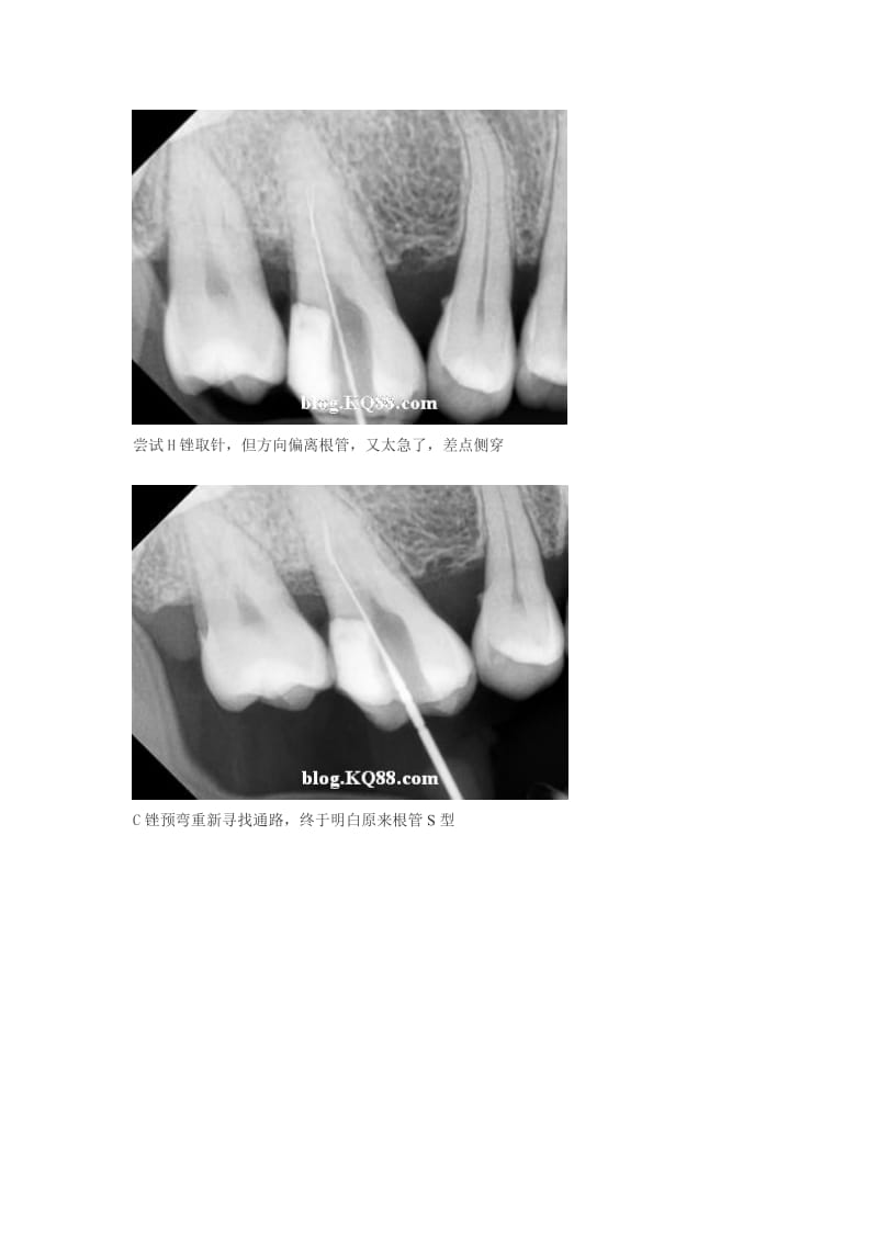 【口腔医学总结】S型根管-断针-取针---小孙医生_第2页