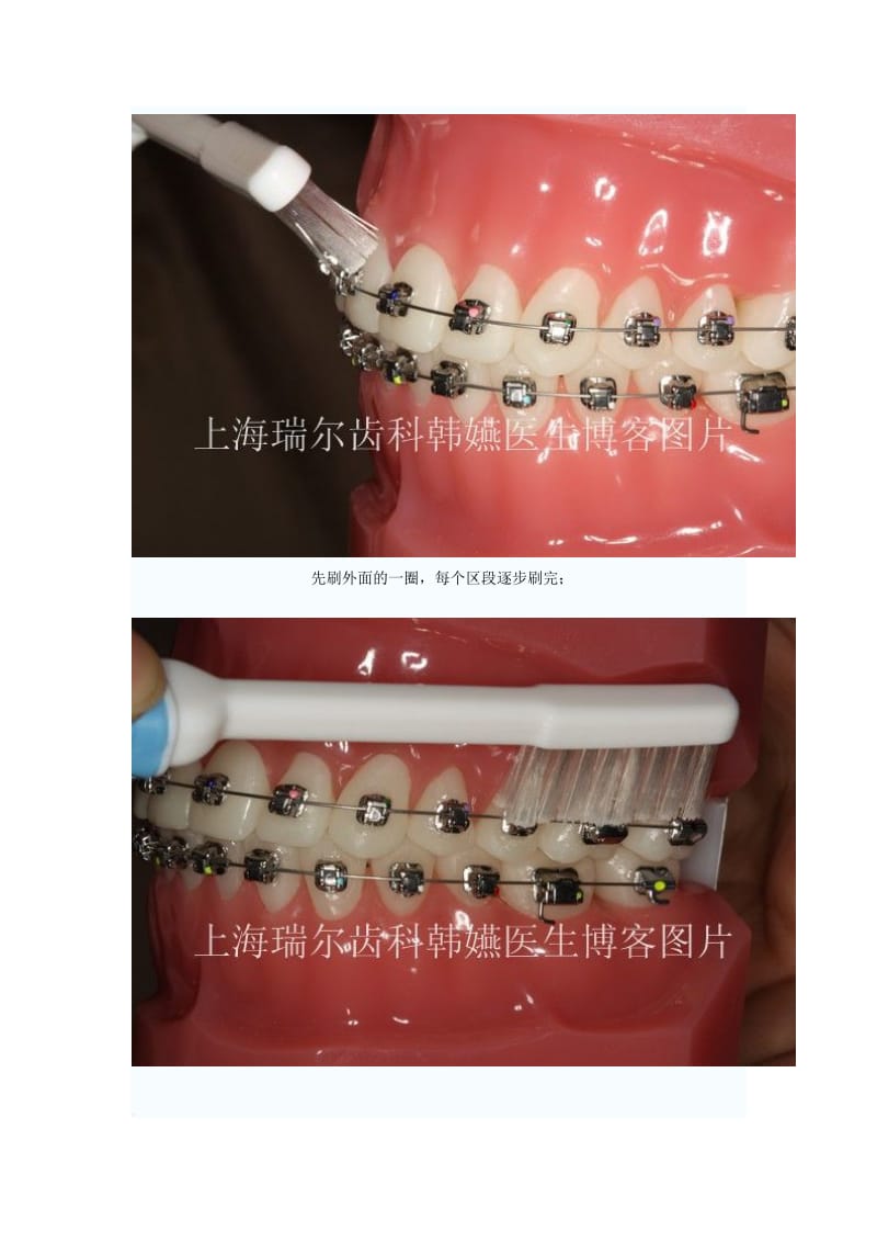 【口腔医学总结】戴牙箍后刷牙方法_第2页