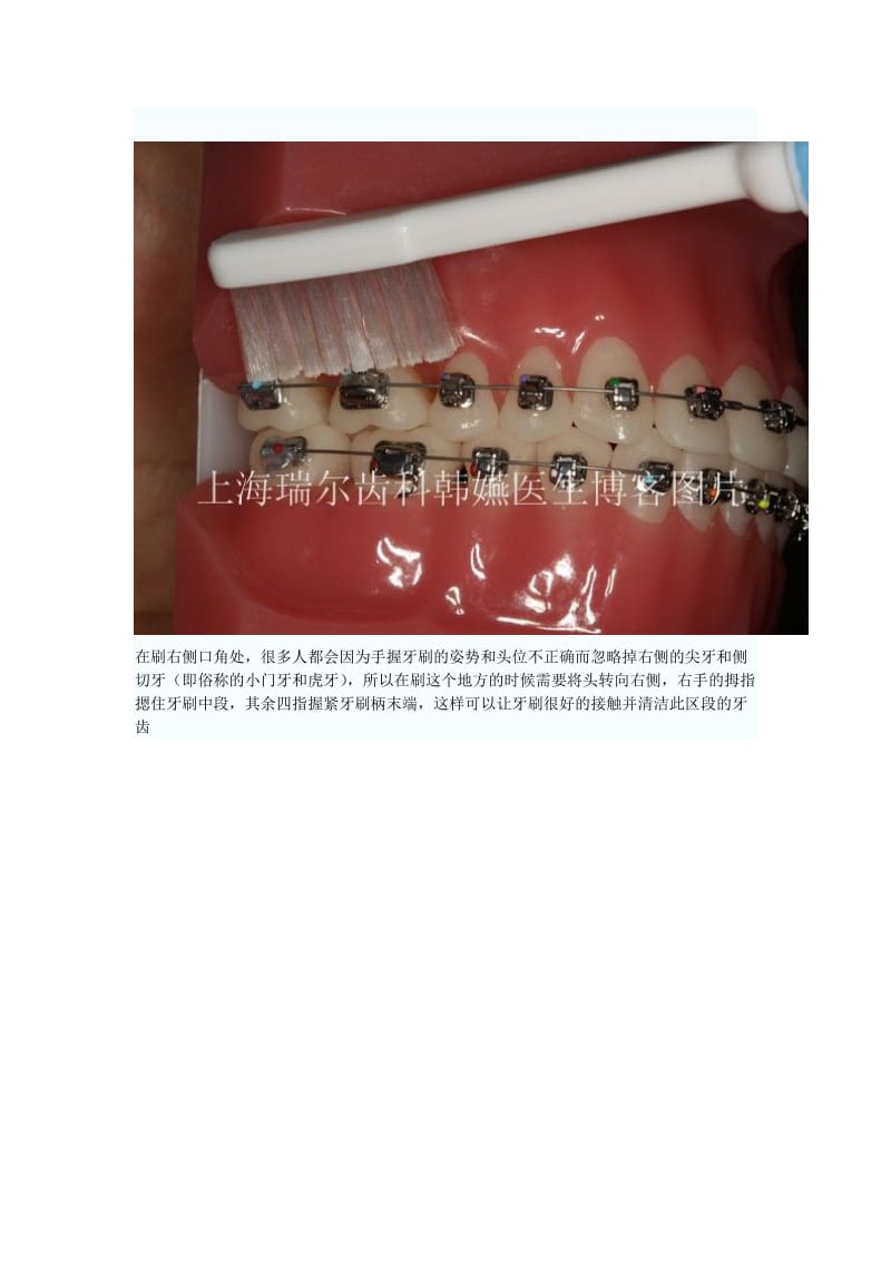 【口腔医学总结】戴牙箍后刷牙方法_第3页