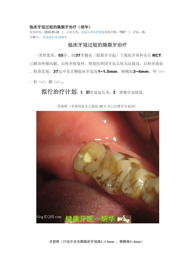 【口腔医学总结】临床牙冠过短的隐裂牙治疗（胡华）_第1页