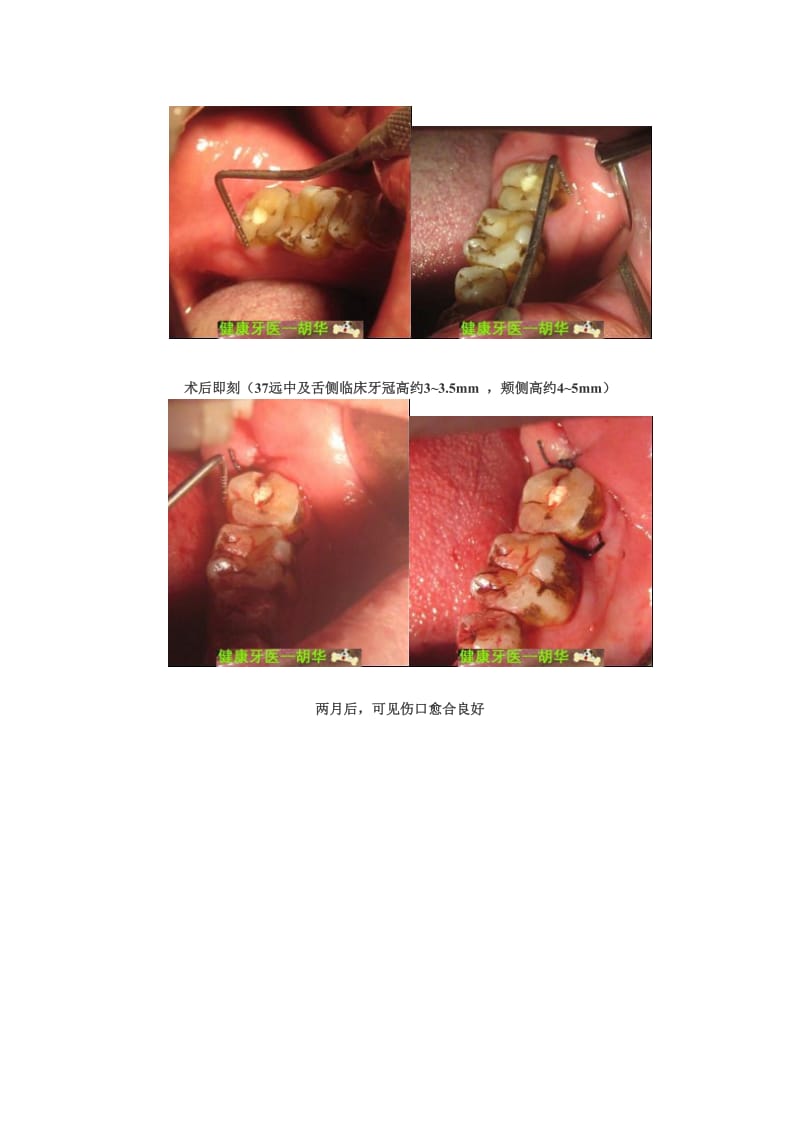 【口腔医学总结】临床牙冠过短的隐裂牙治疗（胡华）_第2页