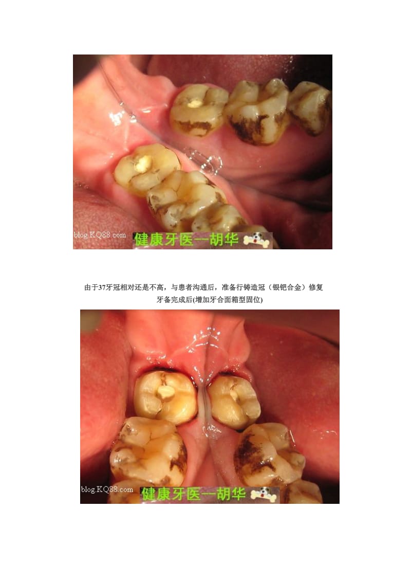 【口腔医学总结】临床牙冠过短的隐裂牙治疗（胡华）_第3页