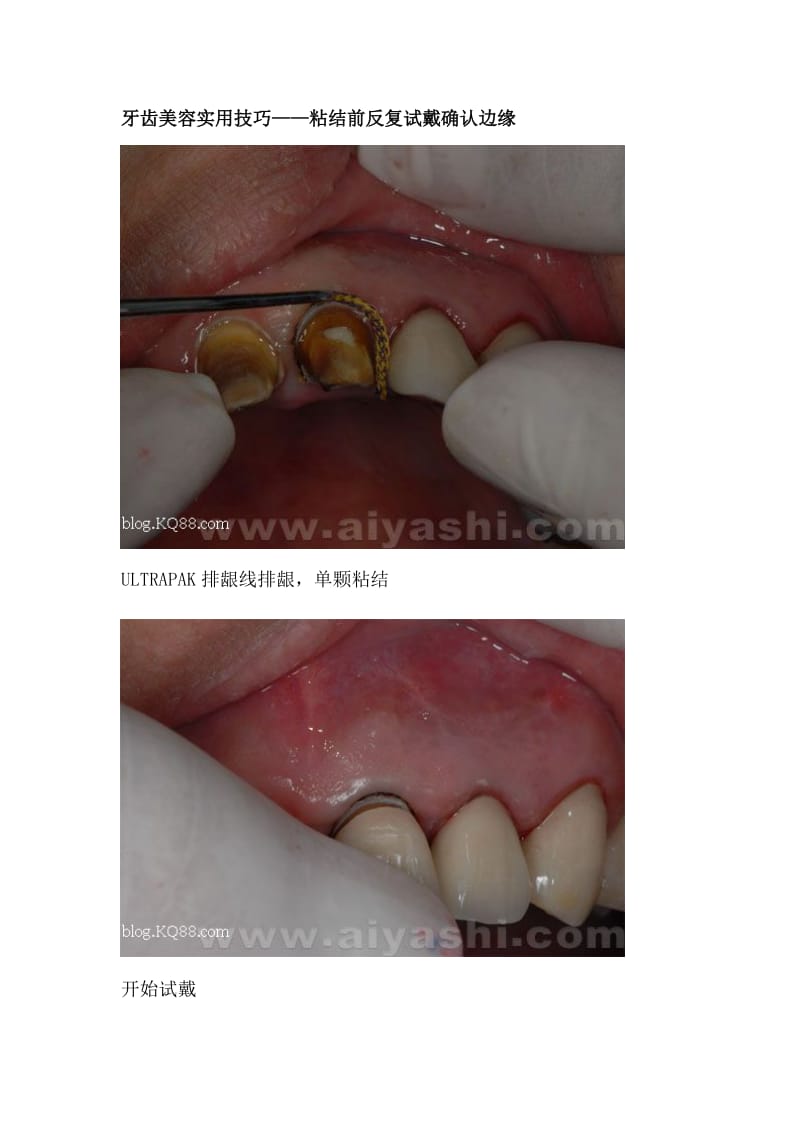【口腔医学总结】烤瓷边缘处理法(林林总总）_第3页