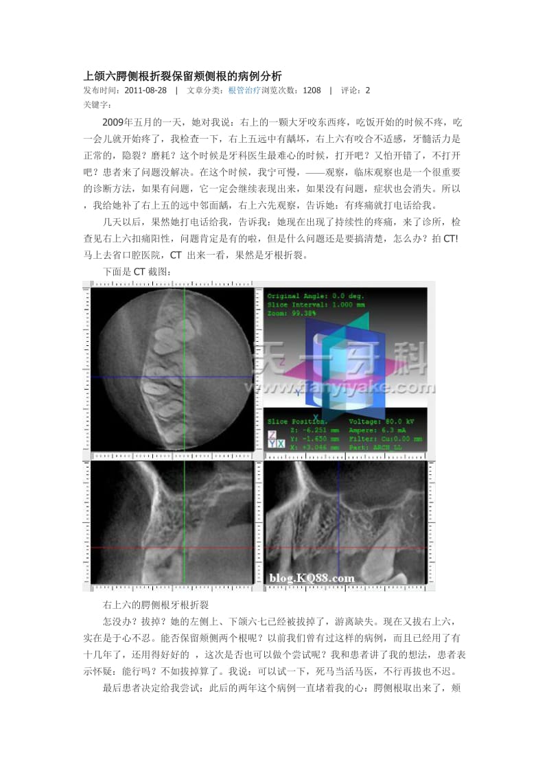 【口腔医学总结】上颌六腭侧根折裂保留颊侧根的病例分析_第1页