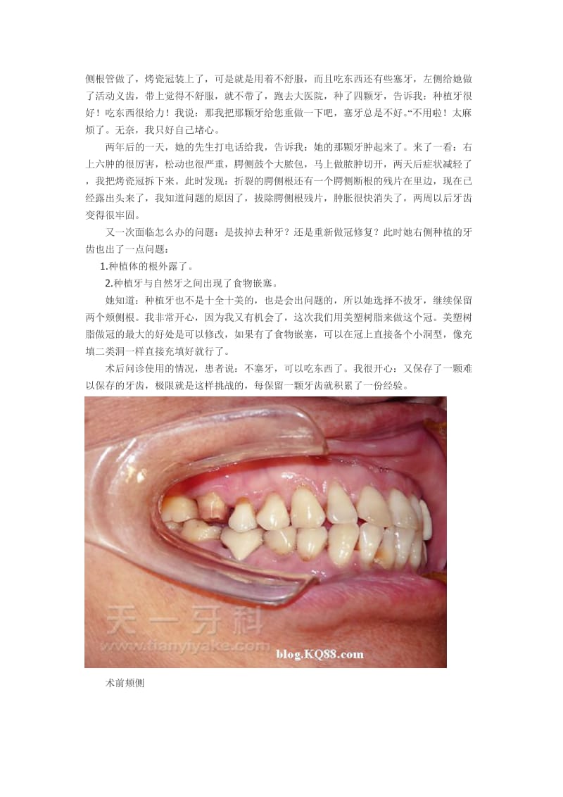 【口腔医学总结】上颌六腭侧根折裂保留颊侧根的病例分析_第2页