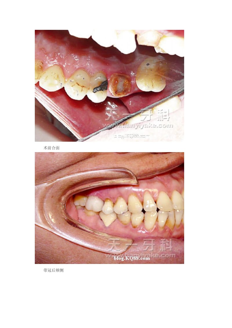 【口腔医学总结】上颌六腭侧根折裂保留颊侧根的病例分析_第3页