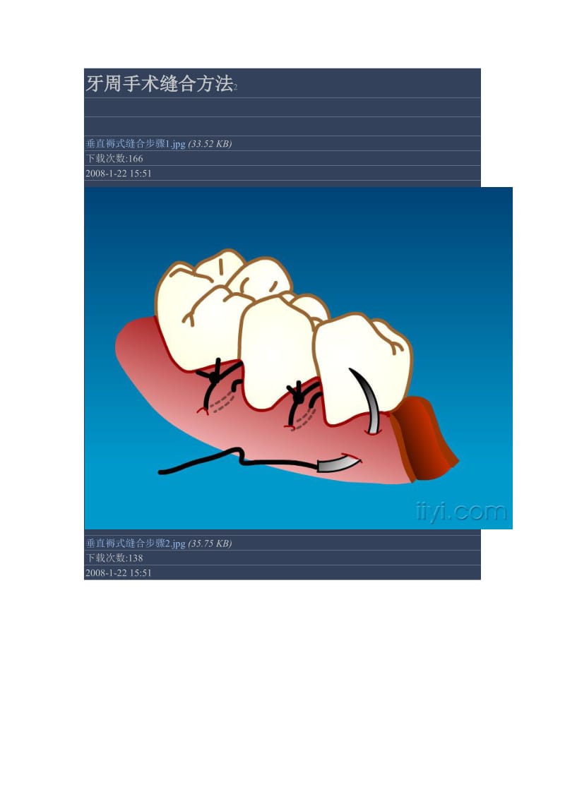 【口腔医学总结】牙周手术缝合方法2_第1页