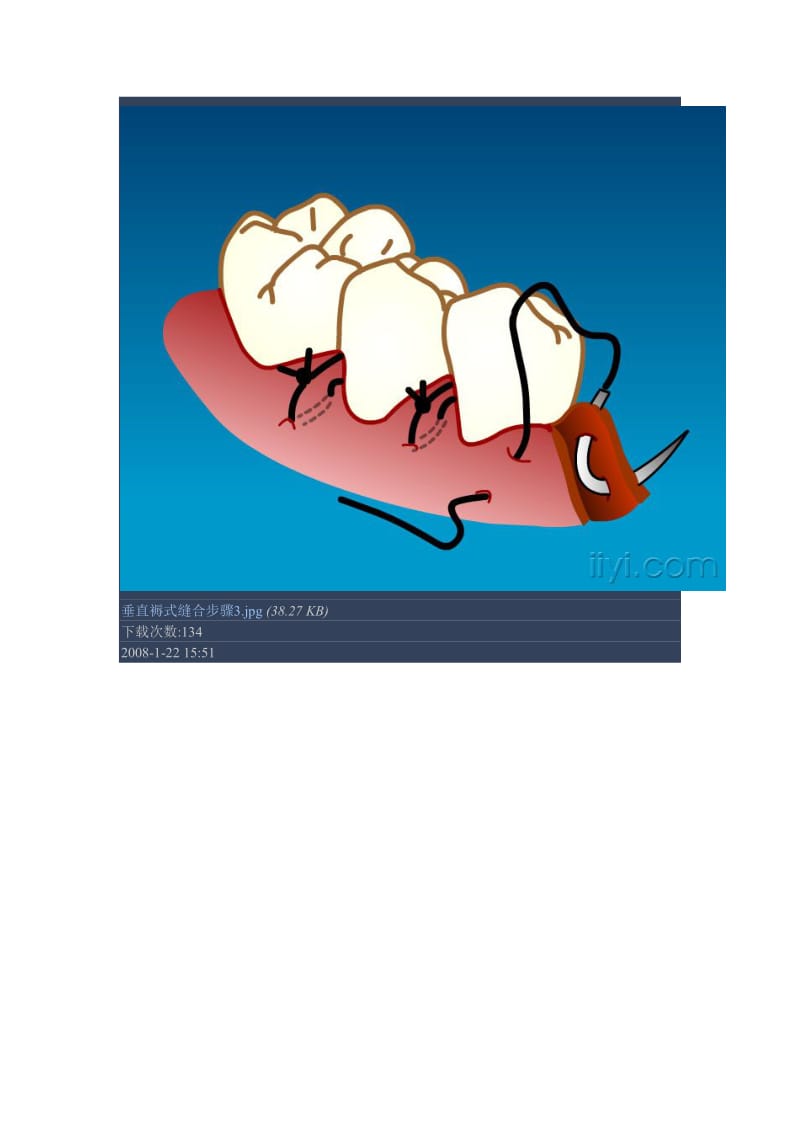 【口腔医学总结】牙周手术缝合方法2_第2页