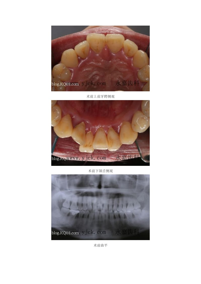 【口腔医学总结】永嘉齿科王笑朵医生的一例牙周病治疗患者_第2页