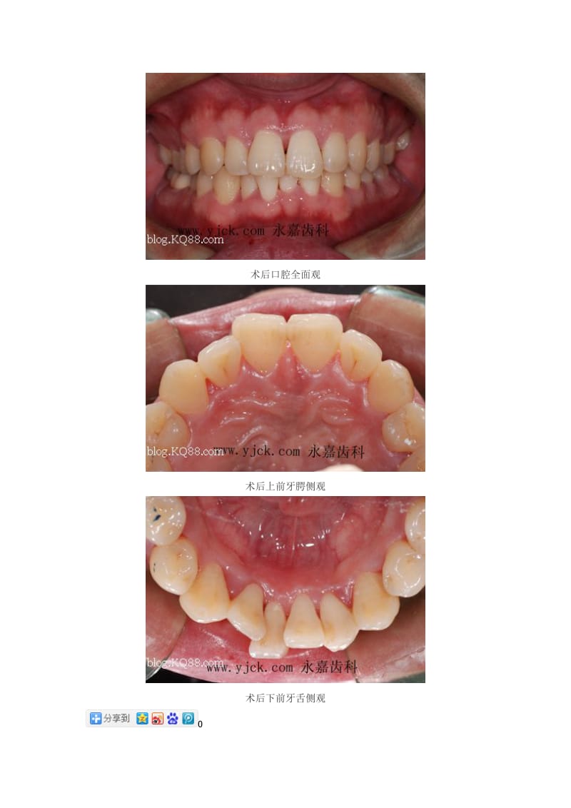 【口腔医学总结】永嘉齿科王笑朵医生的一例牙周病治疗患者_第3页