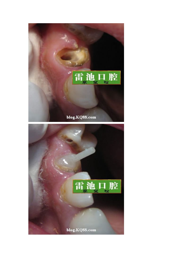 【口腔医学总结】纤维桩+烤瓷冠+树脂修复临牙龋坏_第2页