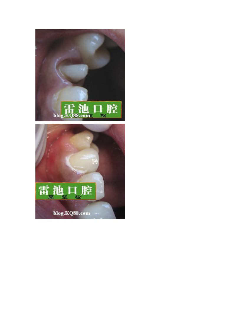【口腔医学总结】纤维桩+烤瓷冠+树脂修复临牙龋坏_第3页