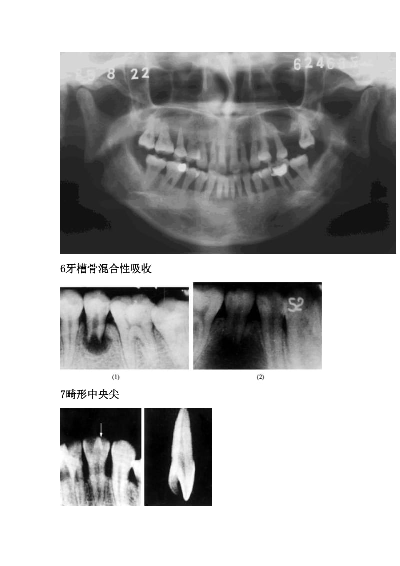 【口腔医学总结】常见口腔临床X线片收集_第3页