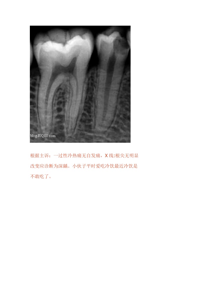 【口腔医学总结】氢氧化钙应用于直接盖髓术的效果观察（记录修复性牙本质的形成）_第2页