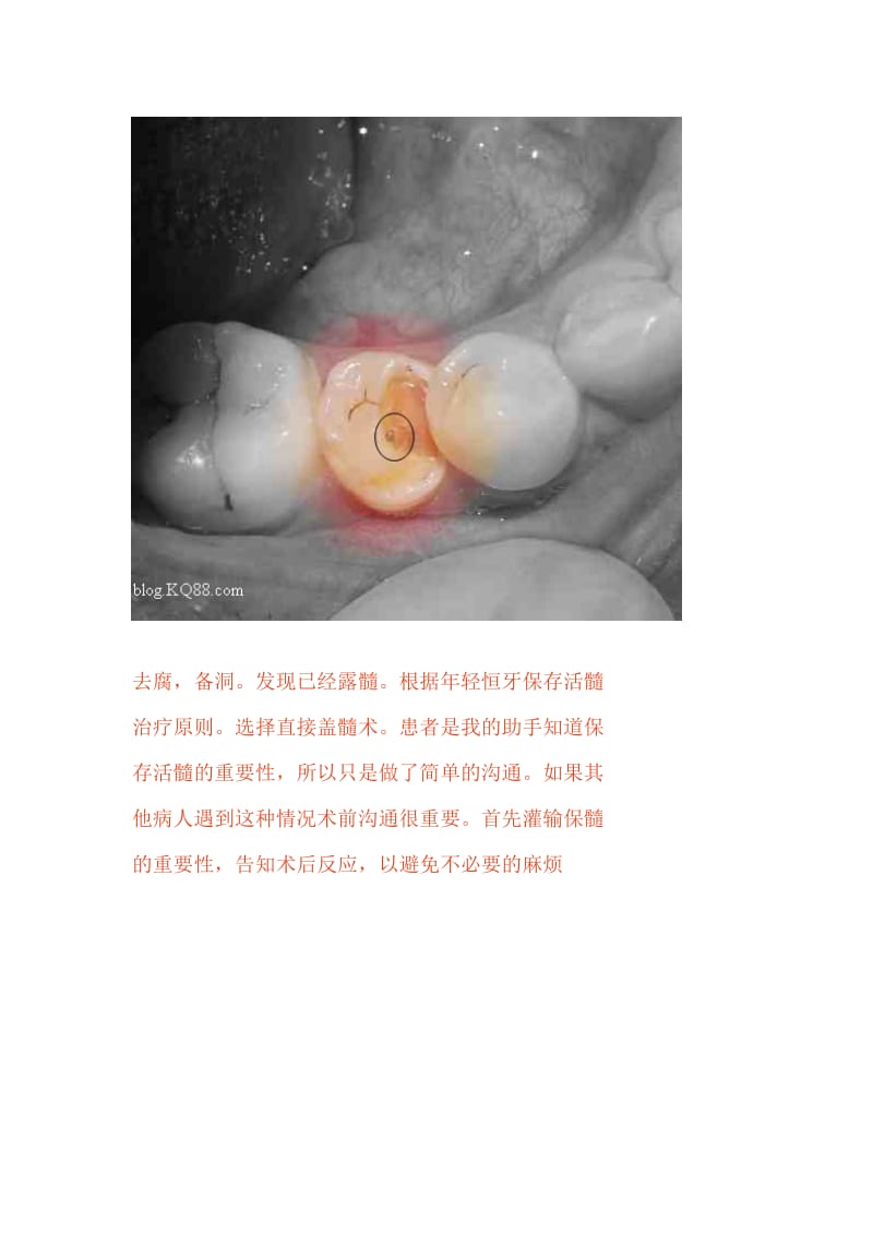 【口腔医学总结】氢氧化钙应用于直接盖髓术的效果观察（记录修复性牙本质的形成）_第3页