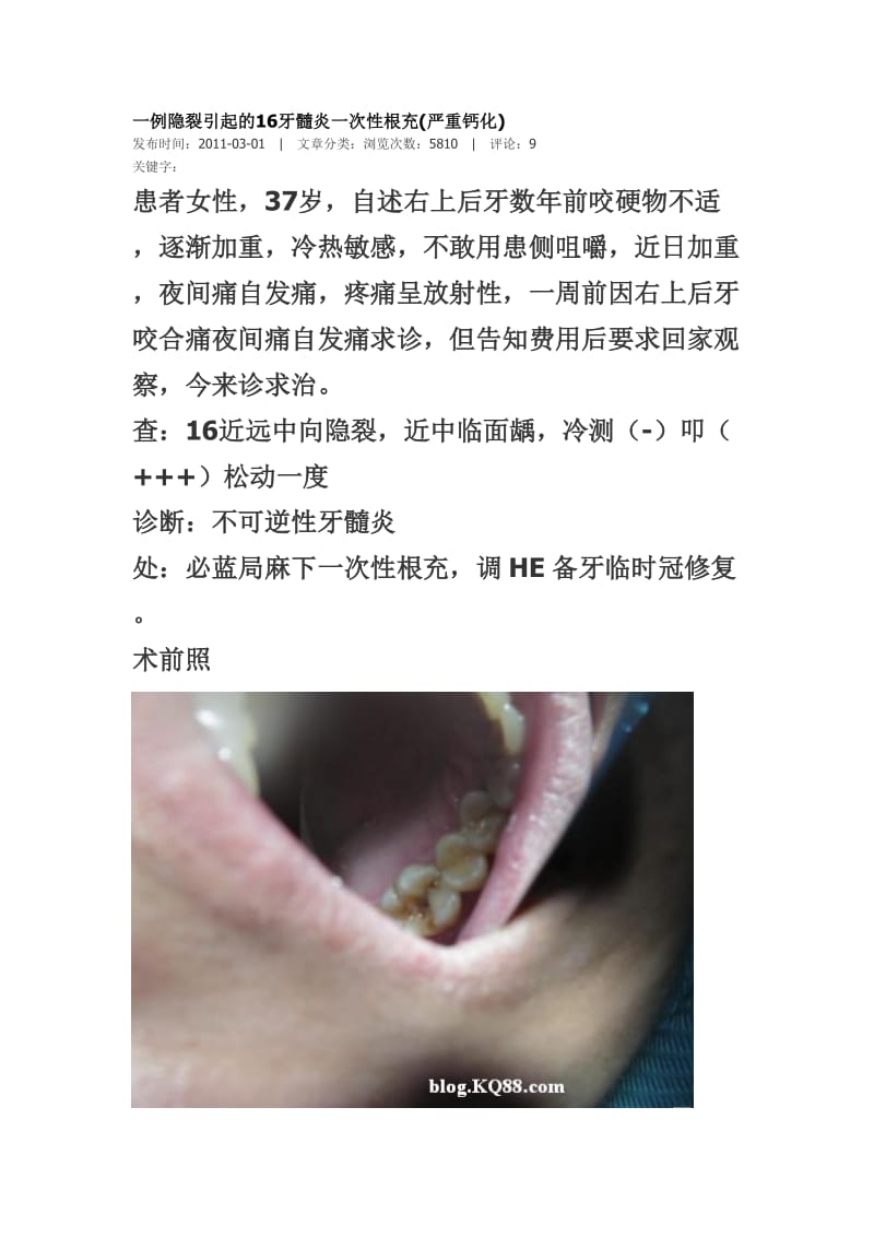 【口腔医学总结】一例隐裂引起的16牙髓炎一次性根充(严重钙化)_第1页