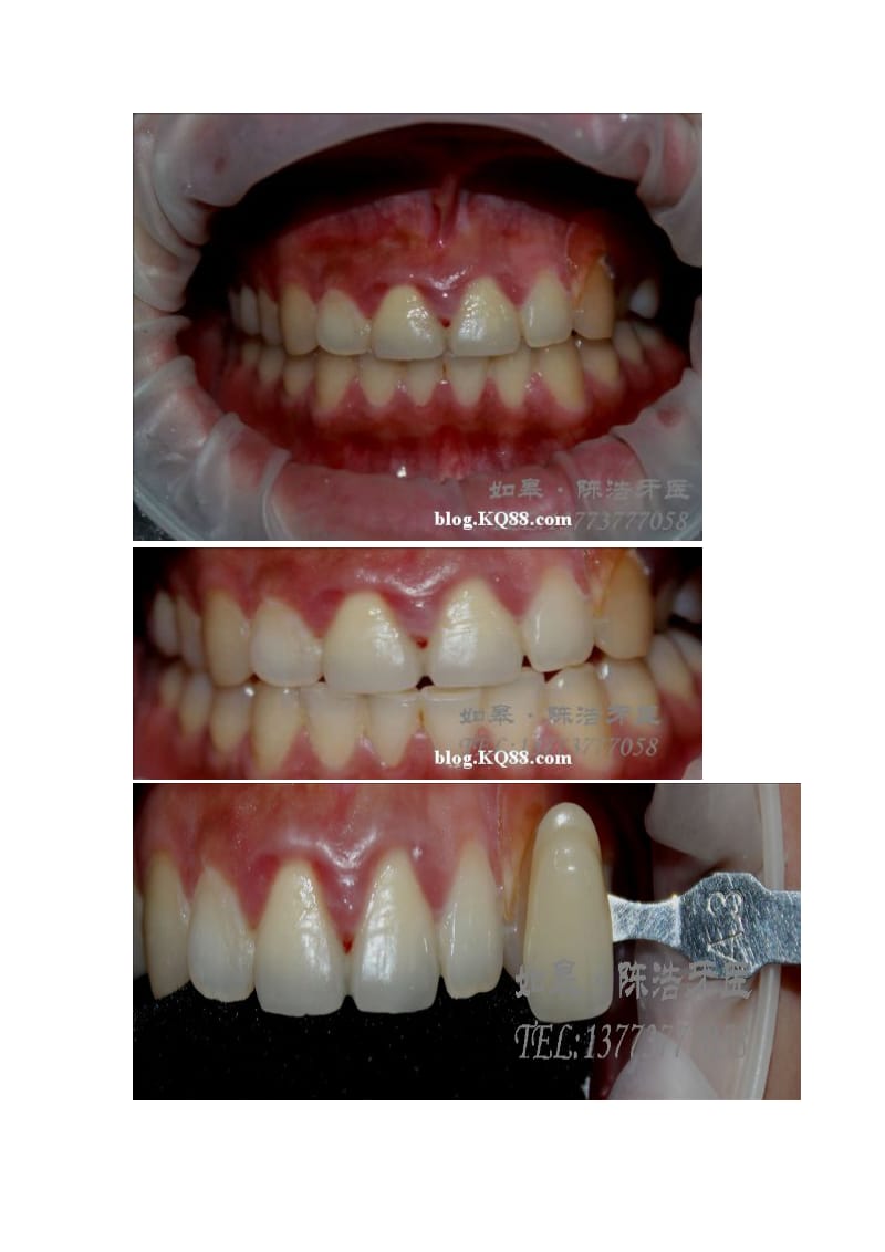 【口腔医学总结】基层牙医的牙齿美白术如皋陈浩牙医_第3页