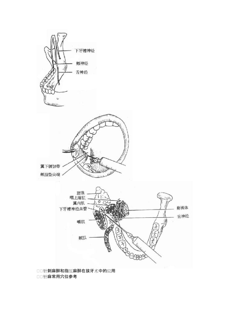 【口腔医学总结】口腔局部麻醉+拔牙术+阻生牙拔除_第3页