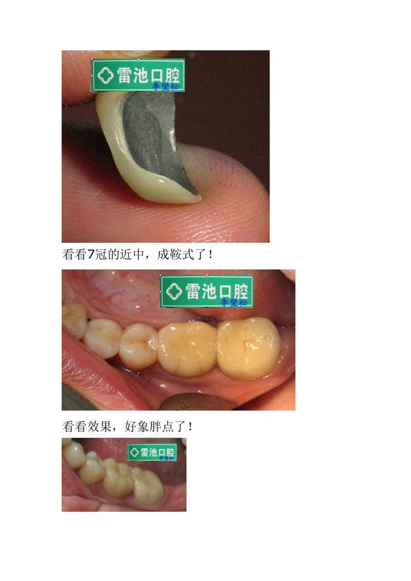 【口腔医学总结】今天处理的一个蹦瓷病例!_第3页
