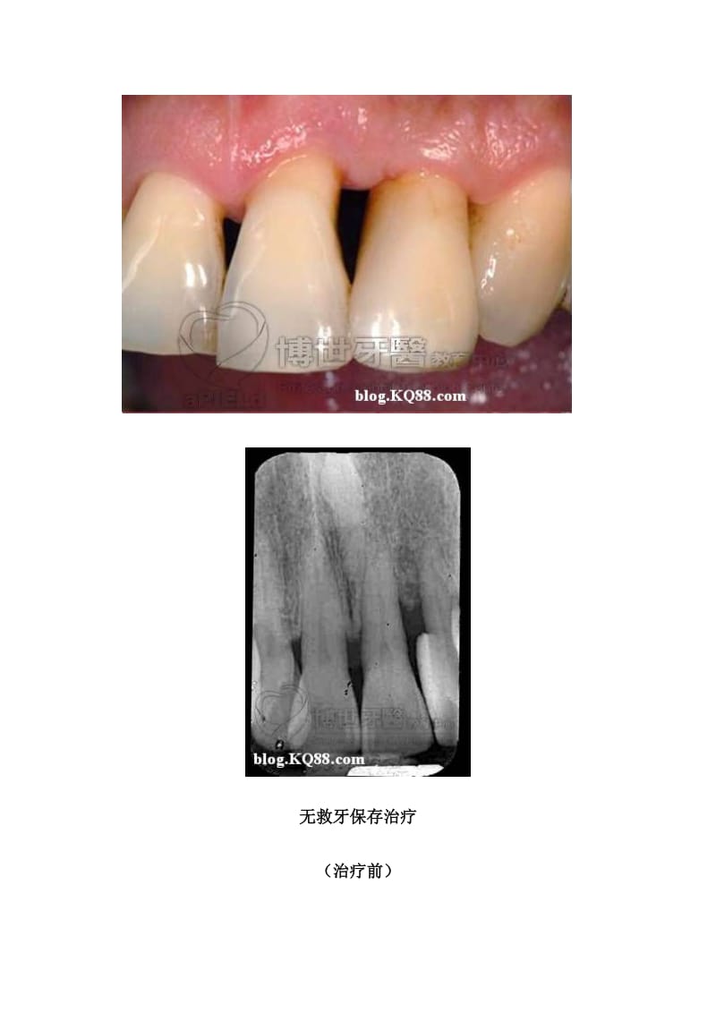 【口腔医学总结】牙周篇-牙周非手术治疗_第3页