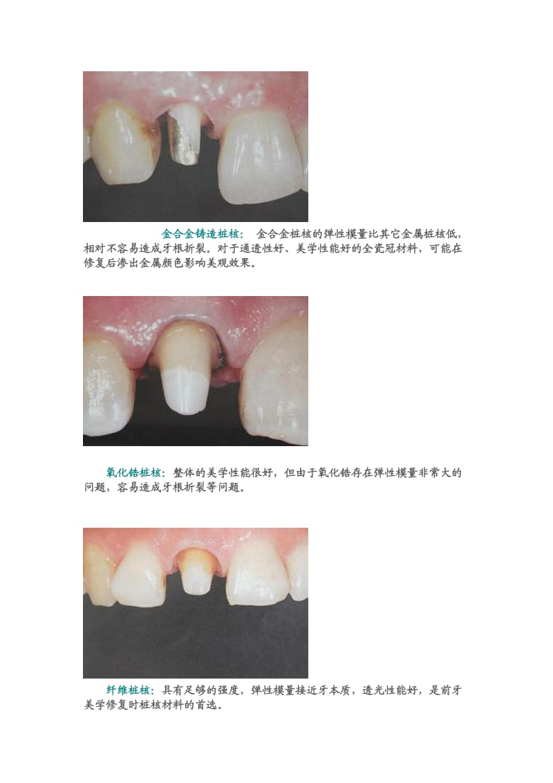 【口腔医学总结】纤维桩修复 之 你该了解的精细操作（安徽小牙）上节_第3页