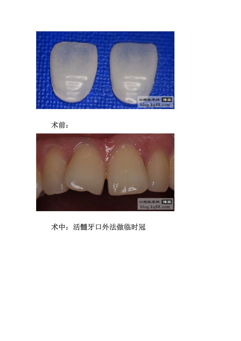 【口腔医学总结】临时冠的制作方法与临床应用----翁林文_第2页