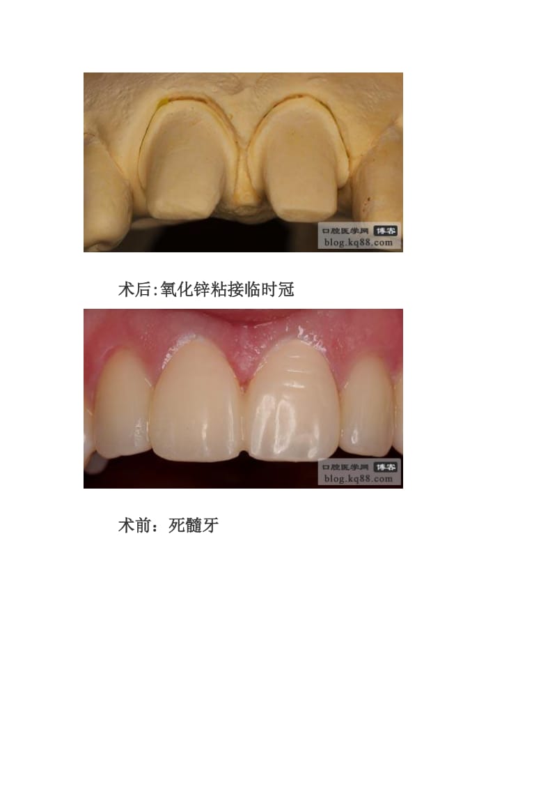 【口腔医学总结】临时冠的制作方法与临床应用----翁林文_第3页