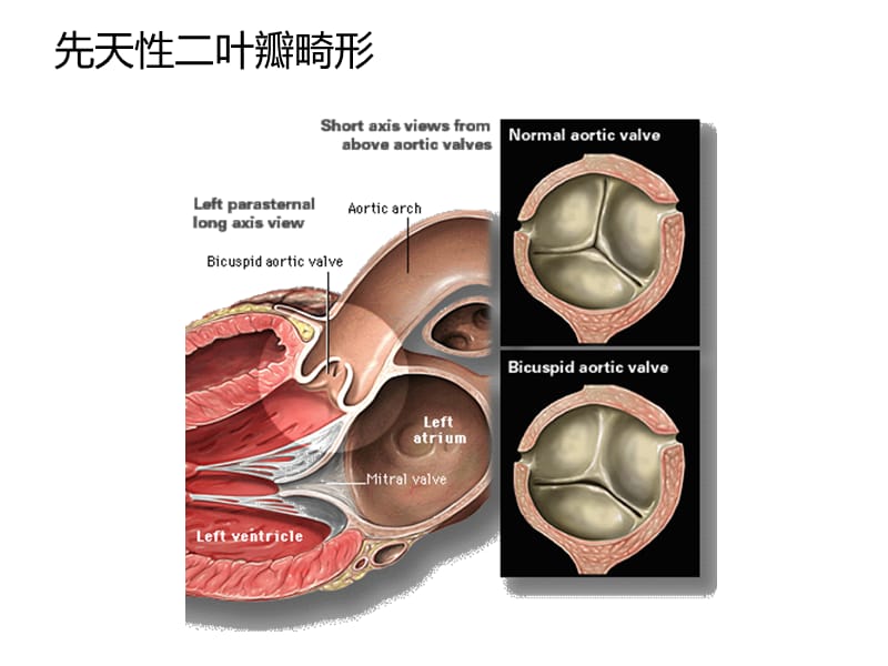 《主动脉瓣狭窄》PPT课件.ppt_第3页