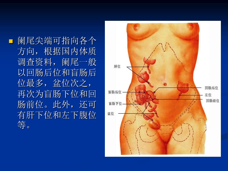 急性化脓性阑尾炎.ppt_第3页