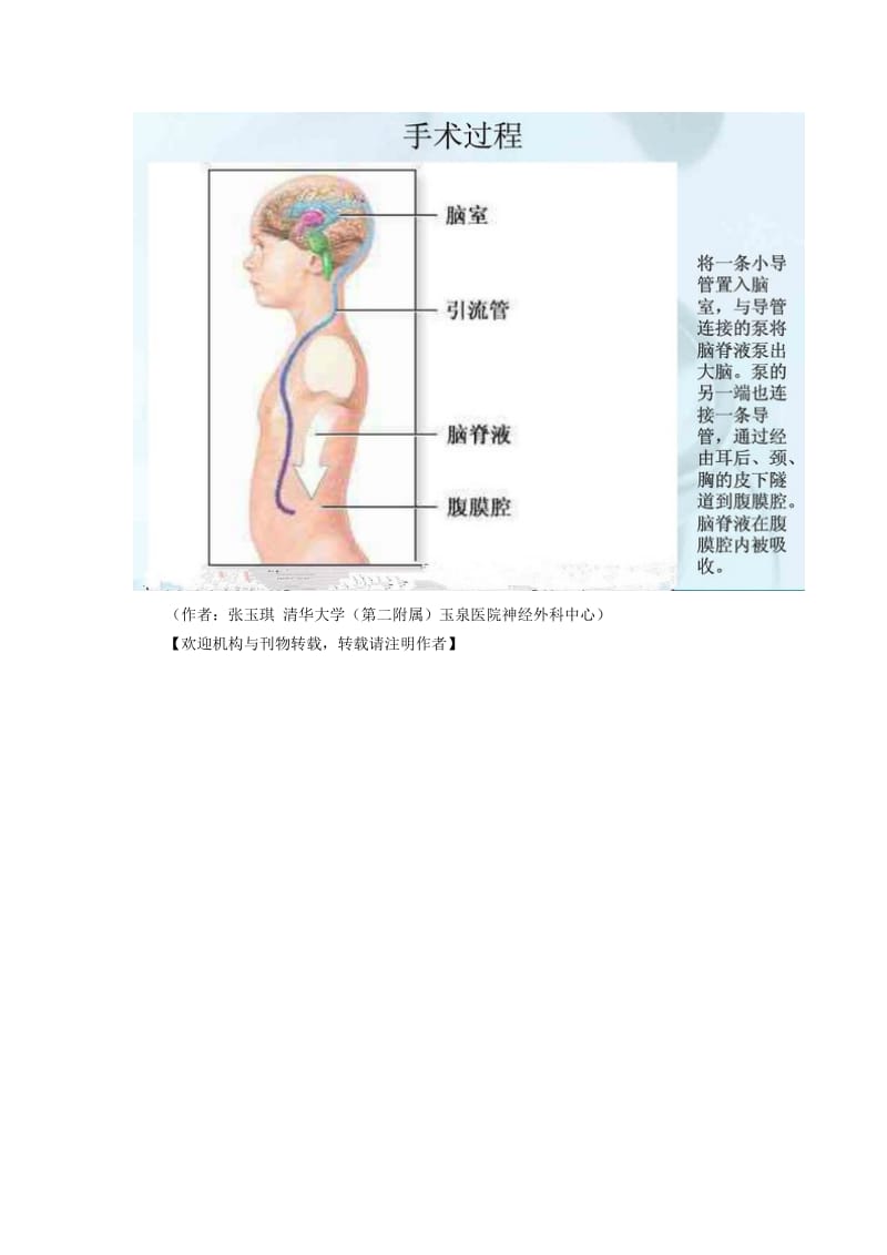 不足一岁幼儿脑积水慎用脑室镜.doc_第3页